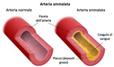 arteriosclerosi