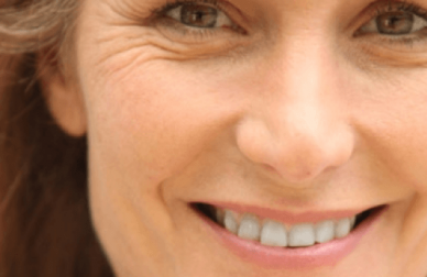 Rughe precoci sul viso, come prevenirle