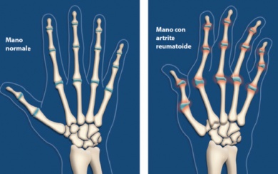 Sintomi dell'artrite: 6 modi per alleviarli