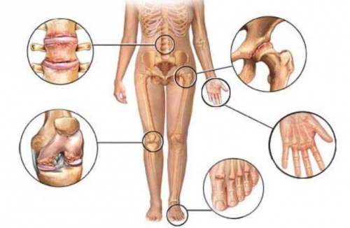 grafico zone colpite dall'artrite