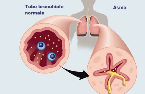 Tubo bronchiale normale e in persona affetta d'asma