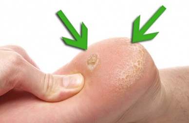 Trattare i duroni in modo naturale, ecco come