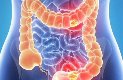 Cancro del colon: come individuarlo in tempo?