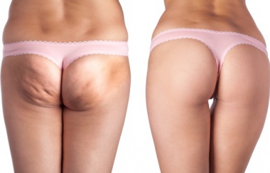 Migliori trattamenti contro la cellulite