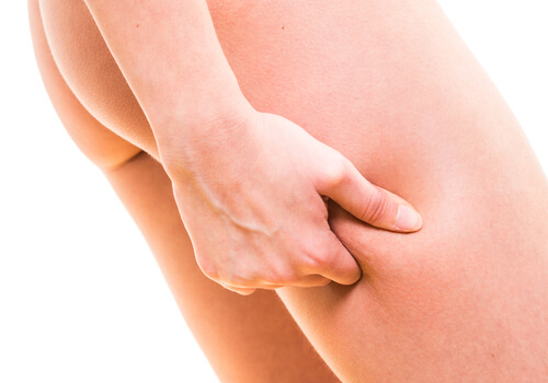 Cellulite