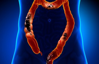 Alimenti da evitare quando si soffre di diverticolosi