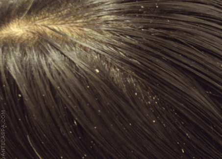 Rimedi naturali contro la forfora