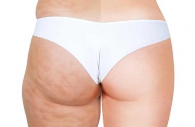 La cellulite: 6 alimenti che la provocano