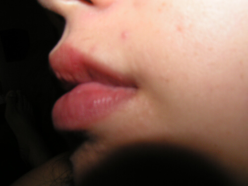 Come curare le afte in bocca