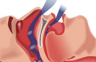 Come trattare l’apnea notturna?