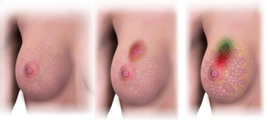 Sapevate che si possono prevenire quattro tumori su dieci?