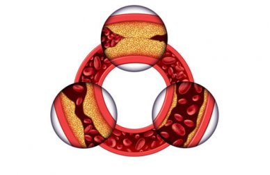 Come ridurre il colesterolo nelle donne?