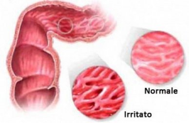 Attenzione! Alimenti proibiti se soffrite di colon irritabile