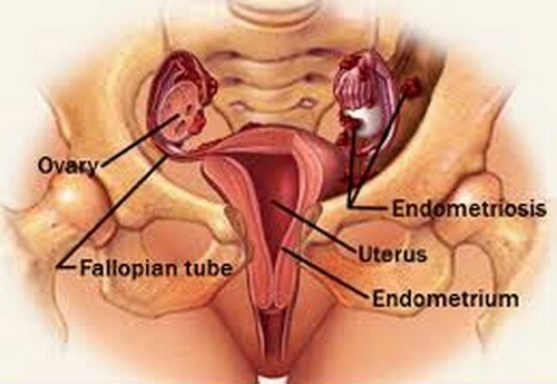 capire l'endometriosi