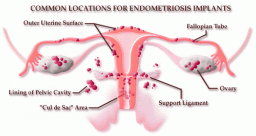 l'endometriosi cos'è