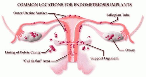 l'endometriosi e come proteggere la vagina