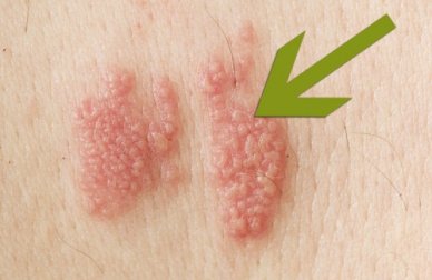 L'Herpes zoster: cos'è e come si manifesta