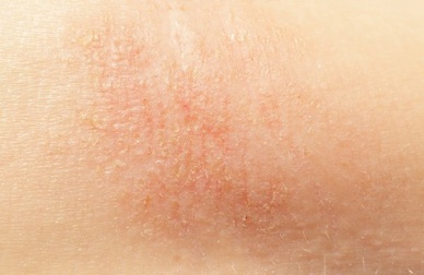 Preparati naturali per la pelle secca