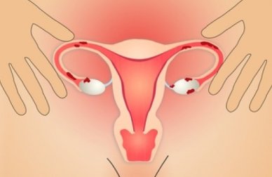 Cause e rimedi per l'endometriosi