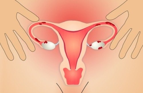 l'interno dell'utero e l'endometriosi