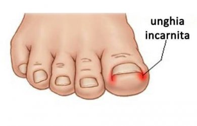 Le unghie incarnite: come evitarle