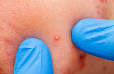 Acne: rimedio al tè verde per eliminarla