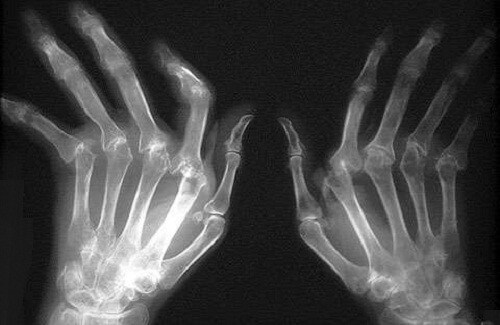 Trattare l'artrite reumatoide in modo naturale