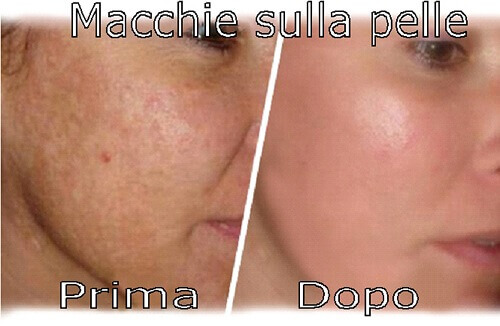 eliminare le macchie della pelle