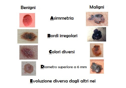 Il metodo ABCDE è un ottimo modo per capire se un nuovo neo potrebbe essere un tumore della pelle o meno