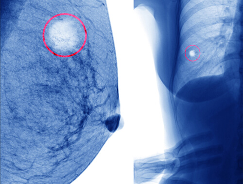 Radiografia cisti al seno