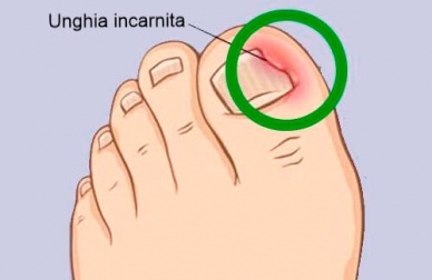 Rimedi naturali per le unghie incarnite