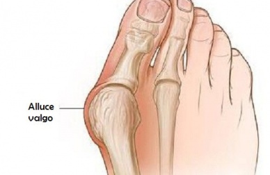 Trattare l'alluce valgo con sei rimedi naturali
