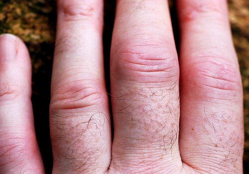 trattare l'artrite mani nocche