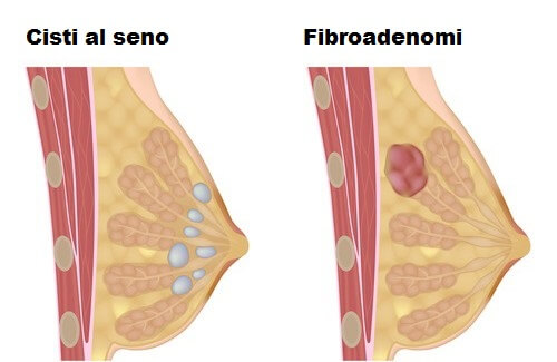 Come evitare le cisti al seno