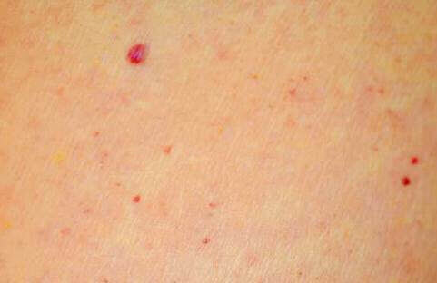 Come sono fatti i nei rossi?