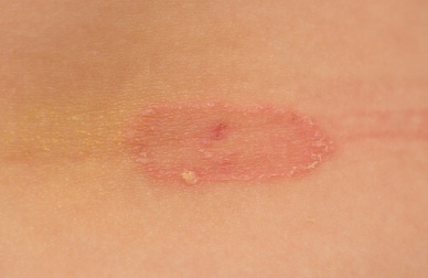 Come prevenire i funghi della pelle?