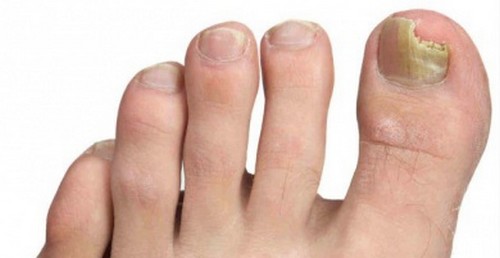 Come prevenire i funghi alle unghie dei piedi