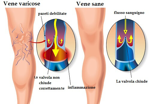 Rimedi per le vene varicose