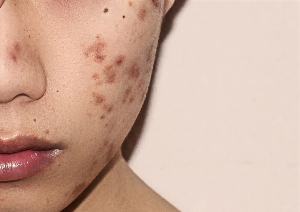 Eliminare I Segni Dell Acne I Migliori Rimedi Naturali Vivere Piu Sani