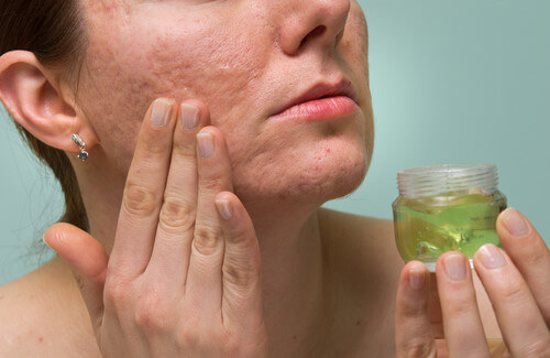 Eliminare I Segni Dell Acne I Migliori Rimedi Naturali Vivere Piu Sani