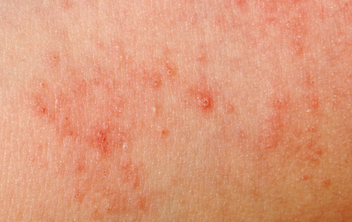 Allergie della pelle: le 10 più comuni