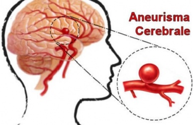 Aneurisma cerebrale: riconoscerlo e prevenirlo