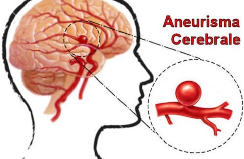 Aneurisma cerebrale