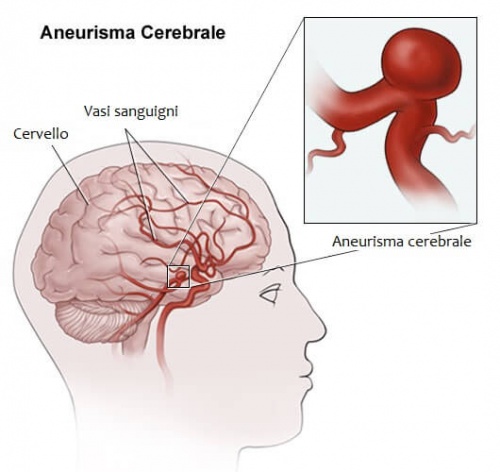 Aneurisma