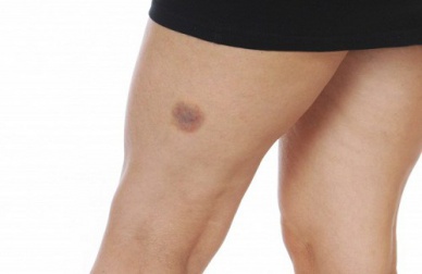 Rimedi naturali molto efficaci per curare i lividi