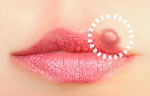 10 trattamenti naturali contro l’herpes labiale 10 trattamenti naturali contro l’herpes labiale