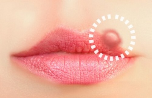 10 trattamenti naturali contro l'herpes labiale