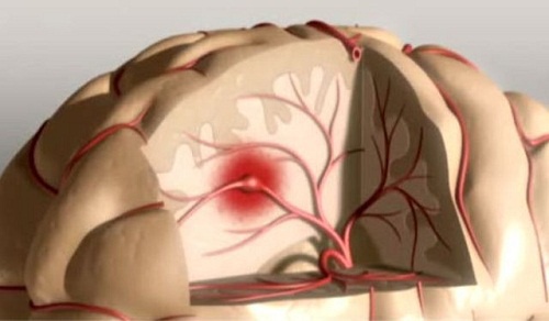 Dormire poco può causare ictus cerebrali
