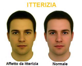 Sintomo di intossicazione del fegato: itterizia