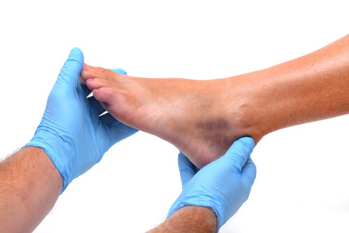 piedi gonfi sintomo di malattia renale
